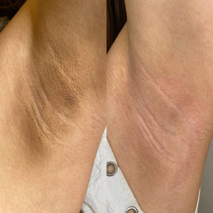 Elura™ Spray quita Manchas con Ácido Kójico